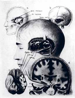 Scoville, W.B., Milner, B. (1957). Loss of memory after bilateral hippocampal lesions. J Neurol Neurosurg Psychiat 20: 11-21.